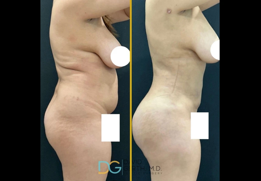 Before and after side profile showing torso with reduced abdominal fullness and enhanced gluteal contour following liposuction and BBL