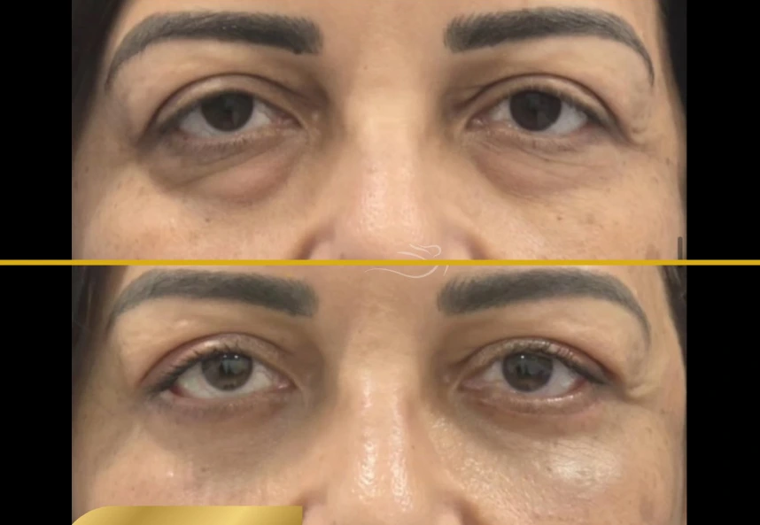 Before and after blepharoplasty showing reduced upper eyelid sagging and improved eye contour