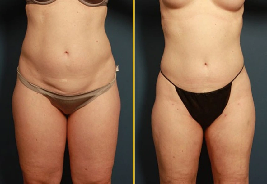 Before and after BodyTite treatment showing abdominal skin tightening results