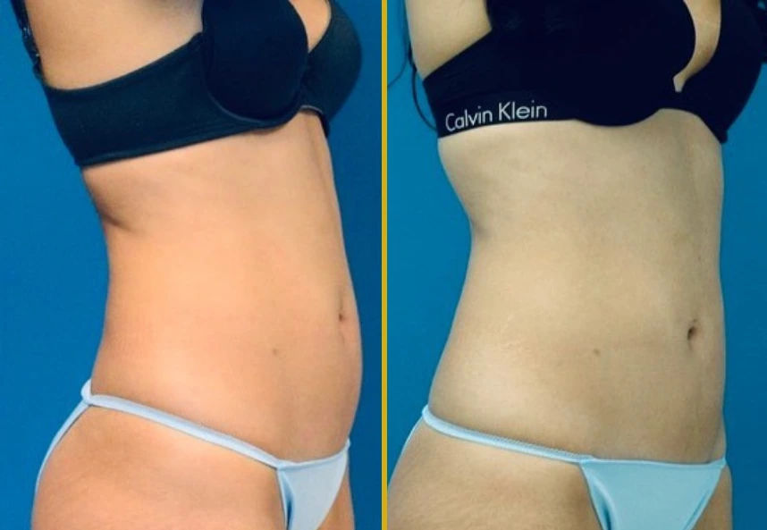 Before and after BodyTite treatment showing improved abdominal contour and skin tightening