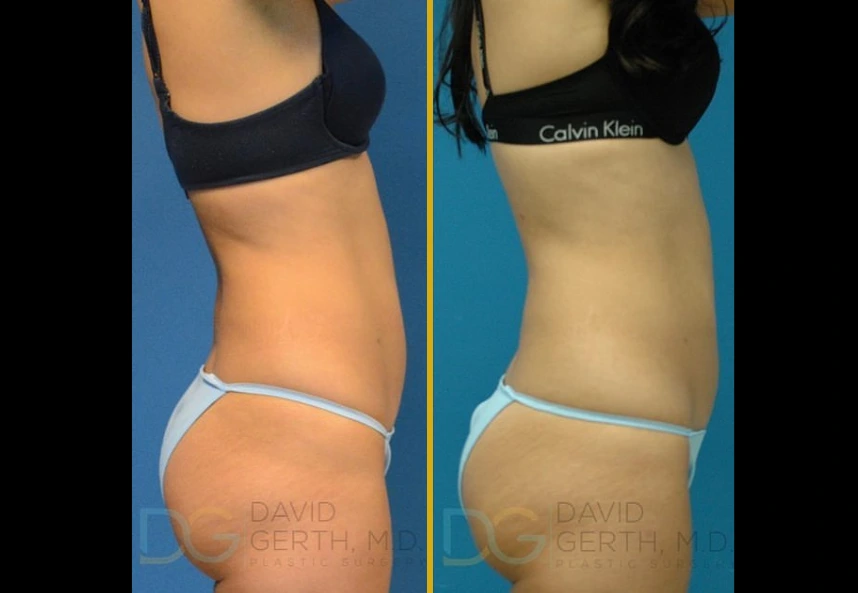 BodyTite before and after result showing torso slimming and skin tightening