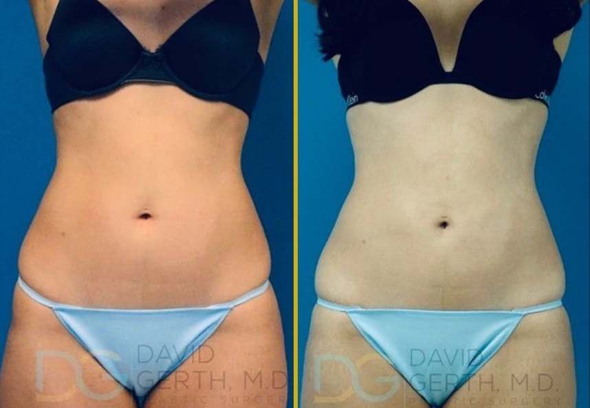 Before and after BodyTite treatment showing abdominal skin tightening results