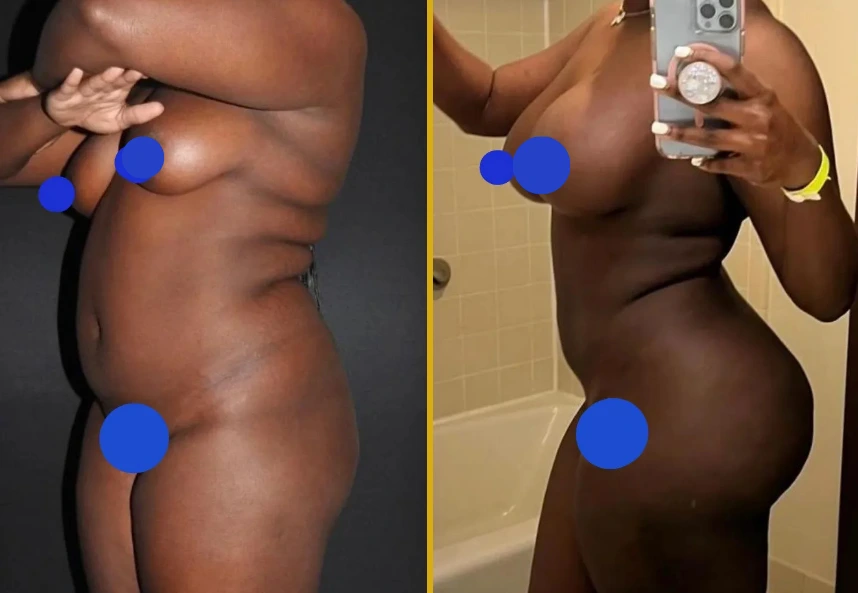 Before and after comparison of breast augmentation with implants, liposuction 360, and BBL results