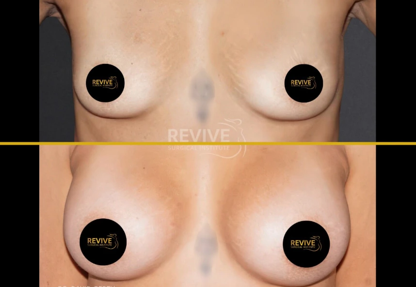 Breast augmentation before and after comparison showing frontal view with Revive Surgical Institute branding