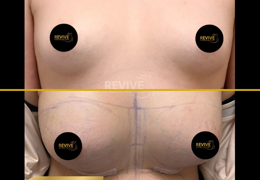 Breast augmentation before and after with Allergan Soft Touch Gel implants, frontal view