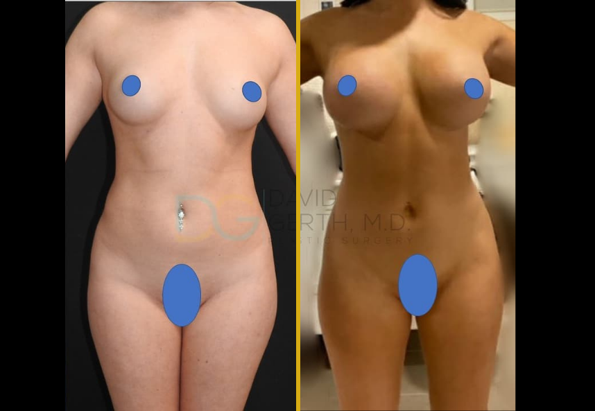 Breast augmentation before and after comparison showing frontal view with patient privacy protection