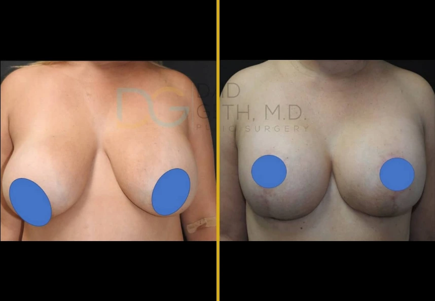 Breast lift with implants before and after comparison, Case 14
