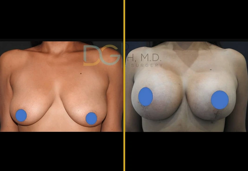 Before and after breast lift with silicone implants, frontal view