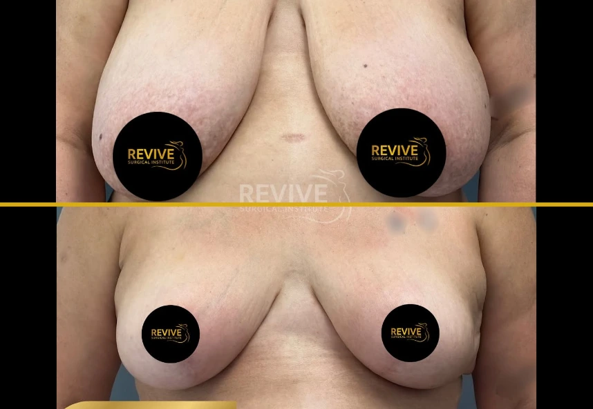 Breast reduction before and after case study showing reduced breast size and improved contour