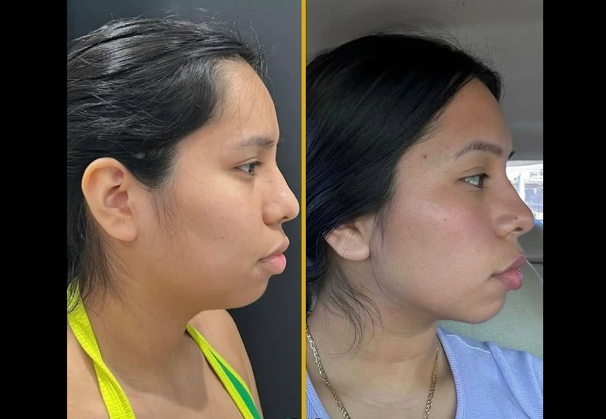 Before and after profile views showing reduced cheek fullness and refined jawline following buccal fat removal and chin liposuction