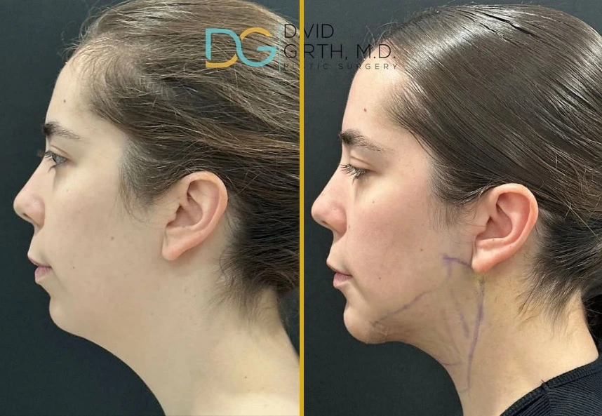 Before and after side profile of chin augmentation with prosthesis and submental liposuction showing improved chin projection and neck contour