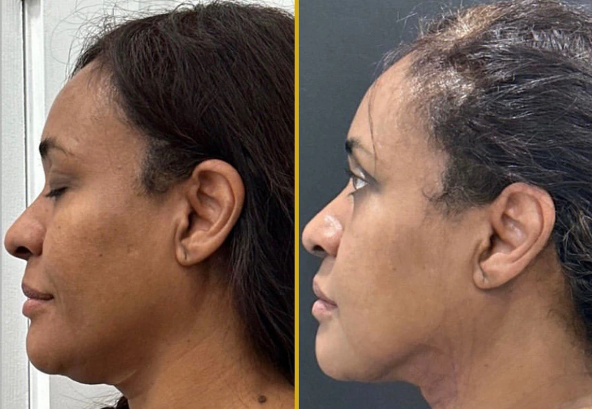 Before and after profile views of chin liposuction case 17, showing reduced submental fullness
