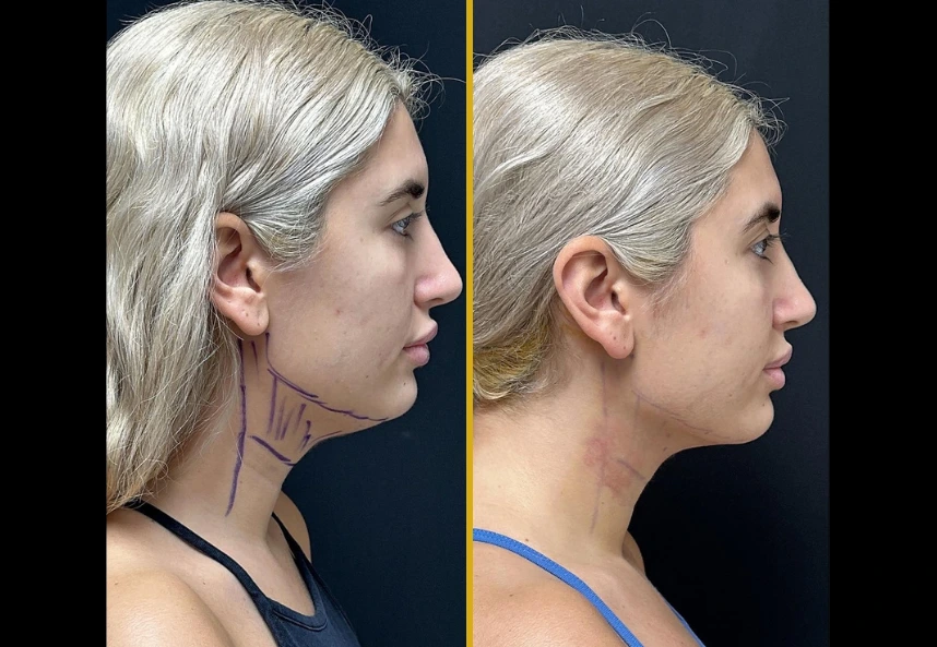 Before and after profile views of chin liposuction results, showing reduced submental fullness