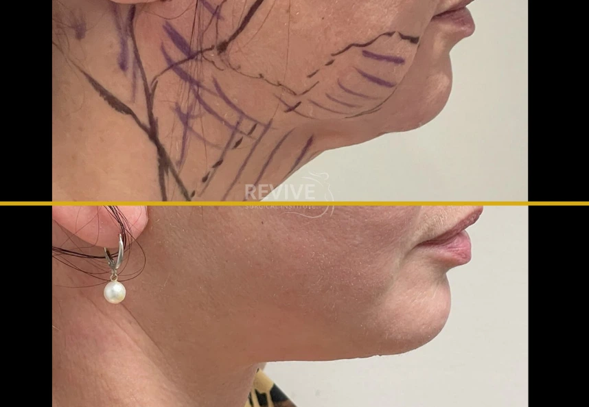 Before and after facelift and neck lift showing surgical markings on upper image and refined jawline and neck contour on lower image