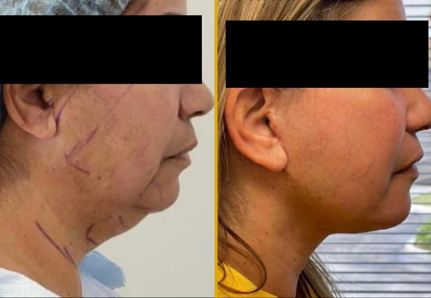 Before and after facelift and neck lift results showing improved jawline definition and skin tightness