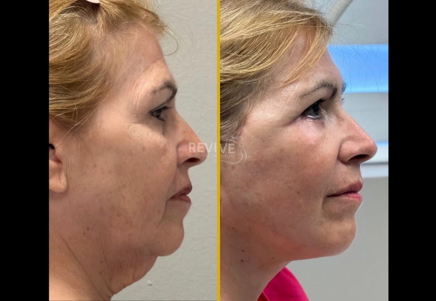 Side-by-side profile comparison of facelift and neck lift results, showing improved jawline definition and skin tightness