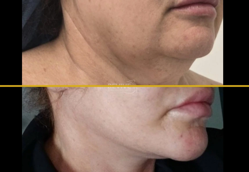 Before and after facelift and neck lift showing improved jawline definition and neck contour
