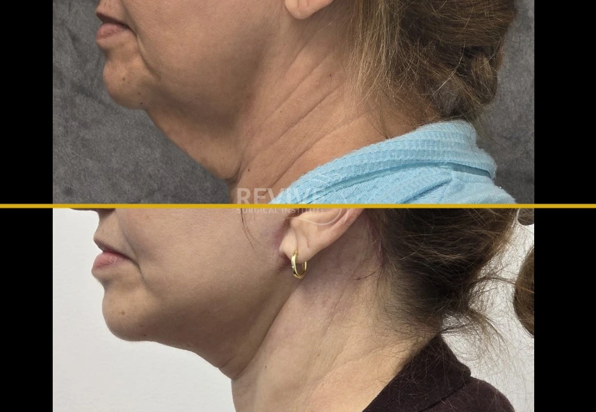 Before and after facelift and neck lift showing improved jawline definition and neck contour from side profile view