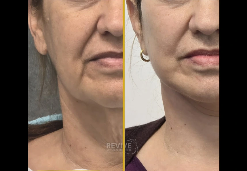 Before and after facelift and neck lift showing improved jawline definition and neck contour