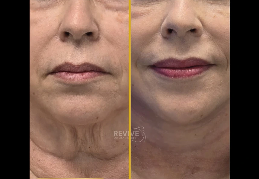 Before and after facelift and neck lift showing improved jawline definition and reduced neck laxity