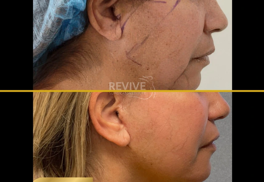 Before and after profile views of facelift and neck lift results showing improved jawline and neck definition