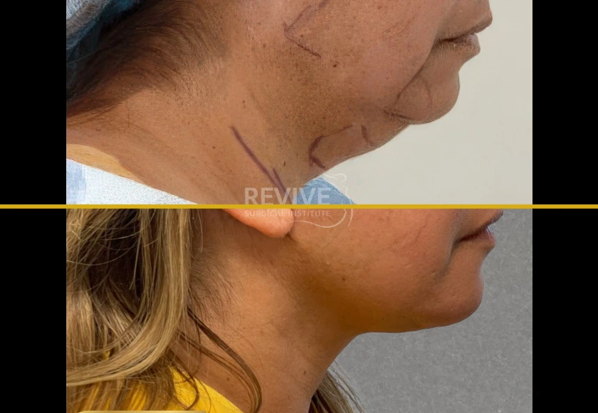 Before and after facelift and neck lift showing improved lower face and neck definition in profile view