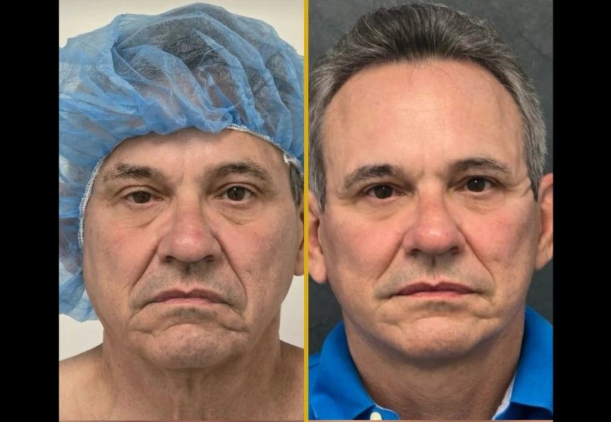 Male patient before facelift with surgical cap, and after facelift showing improved jawline and reduced facial sagging