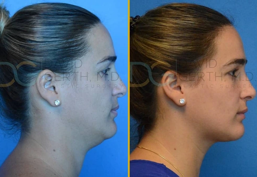 Before and after profile views of a FaceTite case showing improved jawline definition and skin tightening