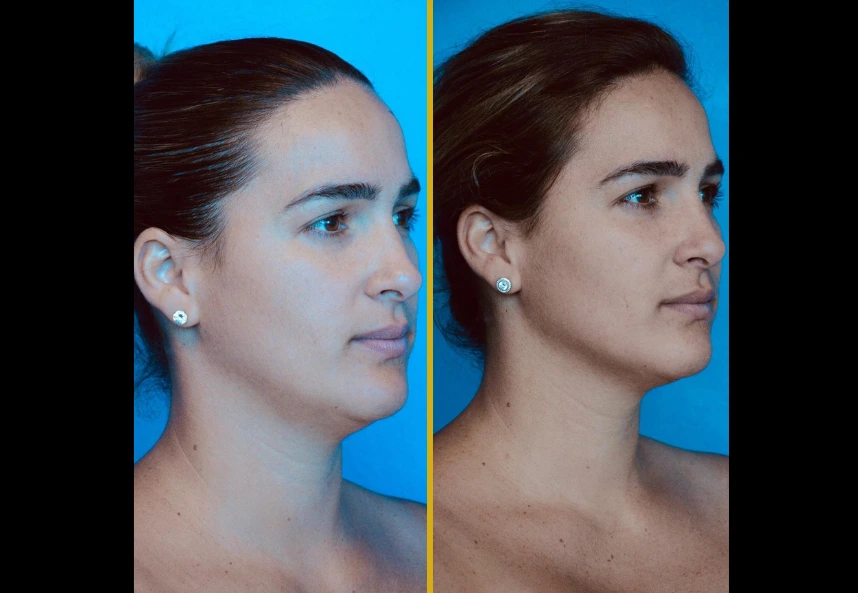 Before and after profile views of a FaceTite patient showing improved jawline definition and skin tightening