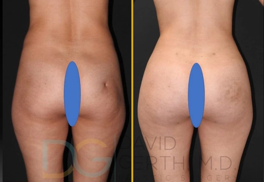 Before and after rear view of a patient's buttocks and lower back showing results of fat transfer and BBL with subcision and fat grafting