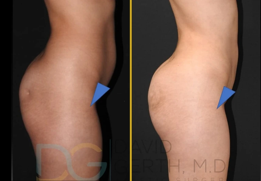 Before and after side profile showing fat transfer and BBL results with improved buttock contour and projection