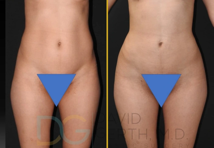 Before and after liposuction case 30 showing fat transfer and BBL with subcision and fat grafting results
