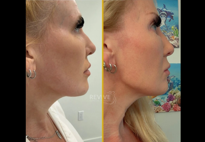Side-by-side before and after profile views of jaw contouring results
