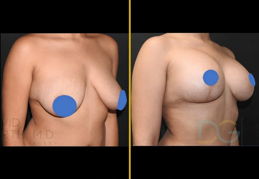 Before and after breast lift with implants showing improved shape and position