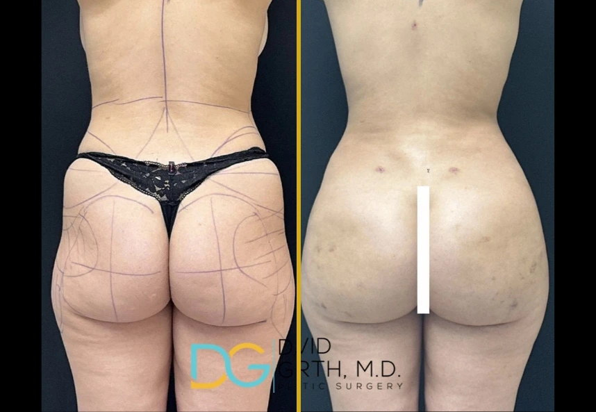 Before and after liposuction 360, BBL, and arm liposuction showing rear view with surgical markings and results