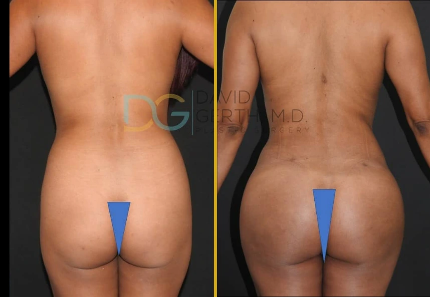 Before and after liposuction 360 and BBL showing rear view with improved body contour and definition