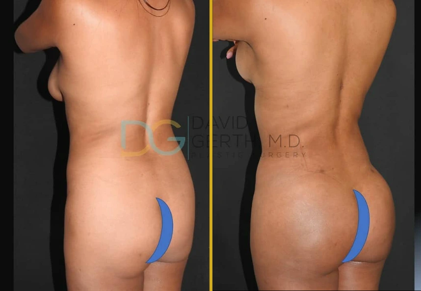Before and after oblique views of a patient's torso and buttocks showing results of liposuction 360, BBL, and JPlasma treatment