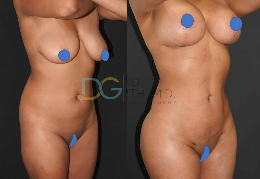 Before and after liposuction 360, BBL, and JPlasma treatment showing torso and lower body contouring results