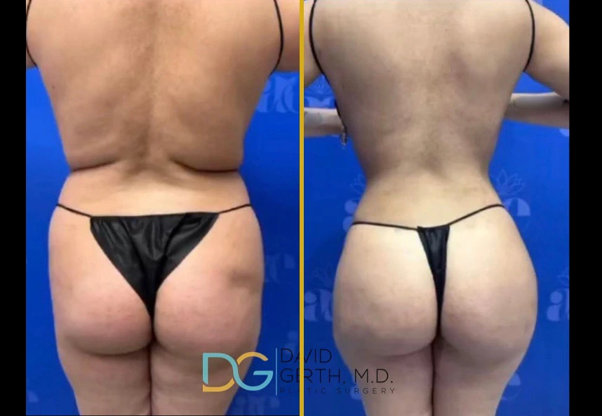 Before and after Lipo 360 + BBL treatment showing back and buttocks transformation