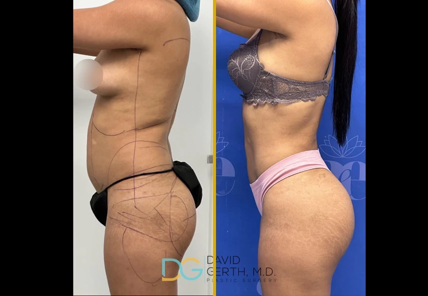 Before and after Lipo 360 + BBL by Dr. David Gerth, M.D., showing side view of torso and buttocks with surgical markings before and sculpted results after
