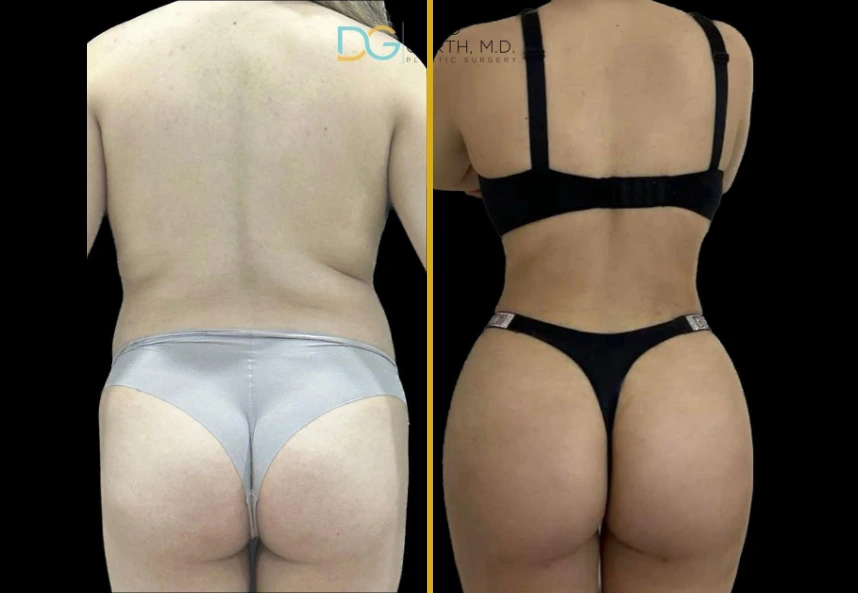 Before and after results of Lipo 360 and BBL procedure showing back and buttock contouring