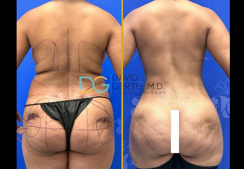 Before and after rear view of liposuction, BBL, and breast lift results with surgical markings