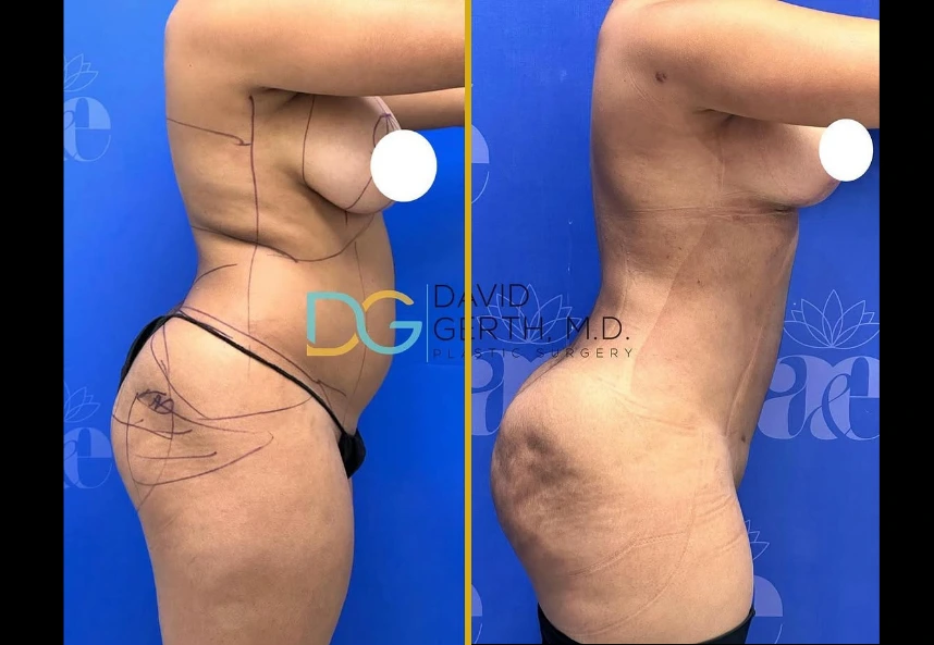 Before and after side profile comparison of liposuction, BBL, and breast lift results