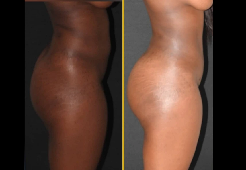 Before and after side profile comparison of Lipo360, BBL, and hip dips treatment results