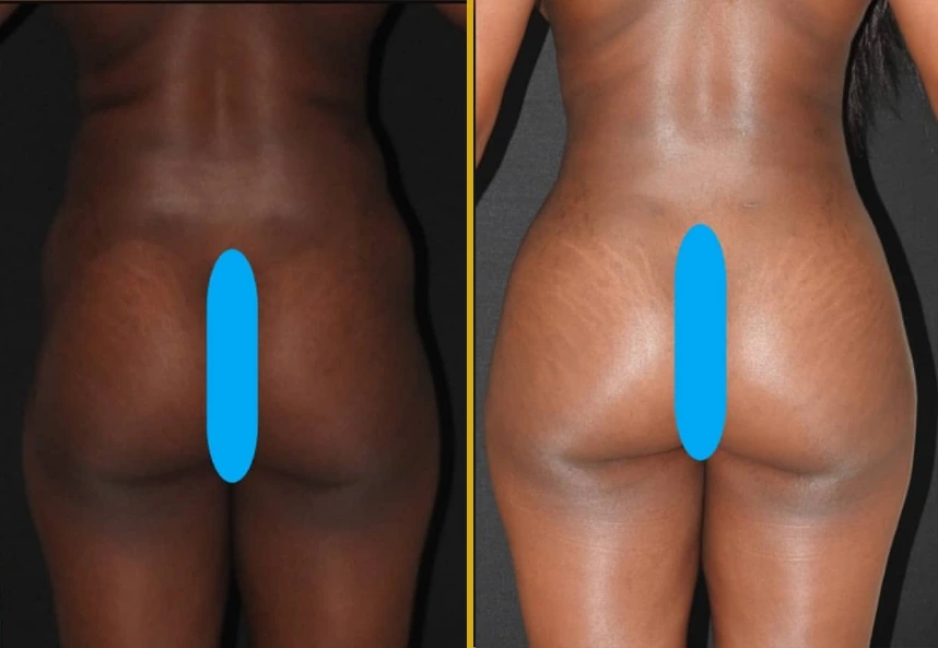 Before and after Lipo360, BBL, and hip dips treatment showing increased volume and contour in buttocks and hip area