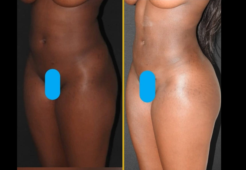 Before and after lipo360, BBL, and hip dips treatment showing improved body contour and gluteal projection