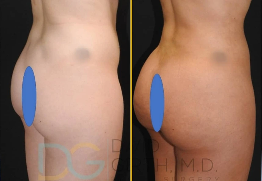 Before and after liposuction and Brazilian butt lift results showing enhanced gluteal contour and reduced flanks