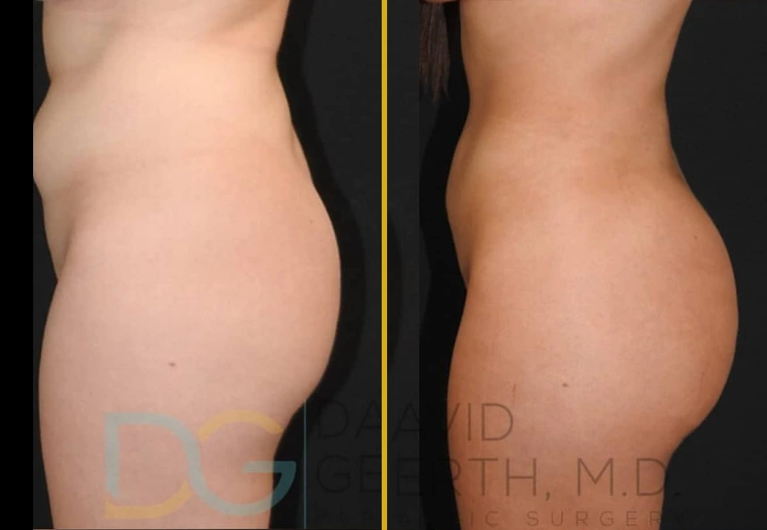 Before and after side profile showing results of Lipo360 and BBL treatment to abdomen and buttocks