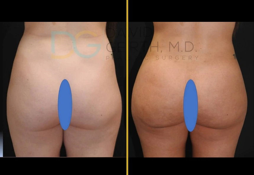 Before and after Lipo360 BBL2 treatment showing posterior view with improved body contour