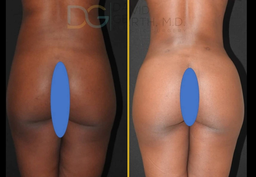 Before and after Lipo360 BBL3 procedure showing enhanced buttock contour and definition